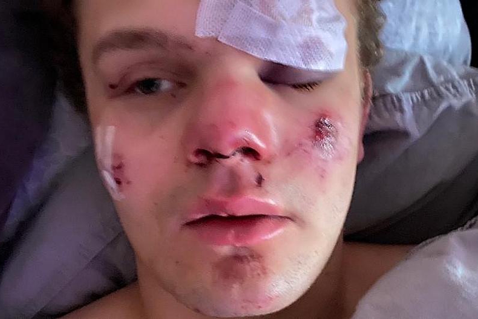 To personer er nu tiltalt efter et groft overfald på 19-årige Lauritz Lindboe Wind i Gothersgade i København tilbage i februar. (Privatfoto).